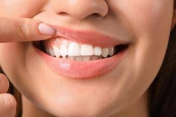 Denti a rischio tra i giovani, Sidp: “Il 36% della Gen Z ha gengive che sanguinano”