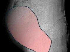 Intervento record al Sant’Anna di Torino, rimosso tumore ovarico di 6 kg
