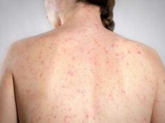 Morbillo, dagli aeroporti Usa alle scuole di Londra: dilagano gli alert