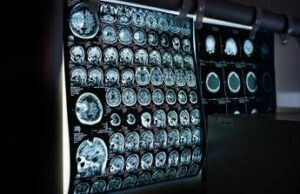 Uno spray nasale ferma l’invecchiamento del cervello, lo studio