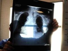 Sirm: “Ai strumento anti liste d’attesa, 50% esami imaging per over70 non necessario”