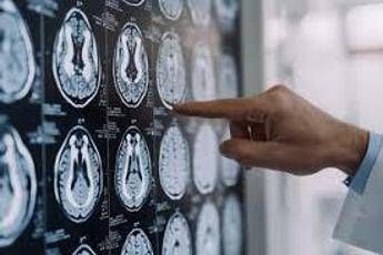 Stop tremori Parkinson senza bisturi, 10 pazienti curati con ultrasuoni a Napoli
