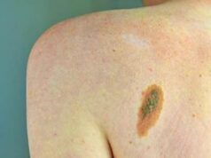 Melanoma, Adoi: “Bene nuova legge su prevenzione, dermatologo centrale in screening”