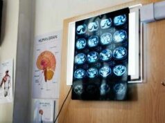 Di Battista, cosa indica un mal di testa forte e improvviso: le ipotesi del neurologo