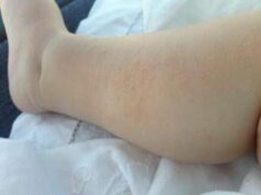 Dermatite atopica, Aifa estende rimborso di upadacitinib dai 12 anni di età