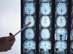 Di Battista e il tumore al cervello, in Italia circa 6mila diagnosi ogni anno: quali sono i sintomi ‘spia’