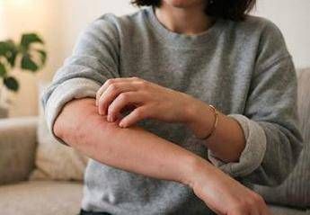Malattia della pioggia, perché se ne parla: cos’è e sintomi