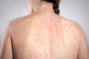 Morbillo, è allarme negli Usa. Italia prima per casi in Europa in in primi 6 mesi 2026