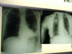 Cancro polmone, con nuova combinazione malattia sotto controllo più a lungo