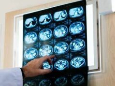 Nodulo polmonare: che cos’è, come si diagnostica e quando intervenire